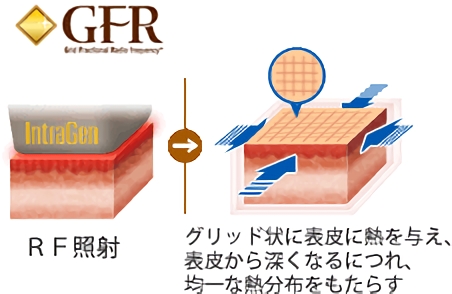 GFR RF照射 → グリッド状に表皮に熱を与え、表皮から深くなるにつれ、 均一な熱分布をもたらす