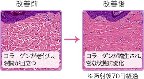 改善前 コラーゲンが老化し、隙間が目立つ 改善後 コラーゲンが増生され、密な状態に変化 ※照射後70日経過