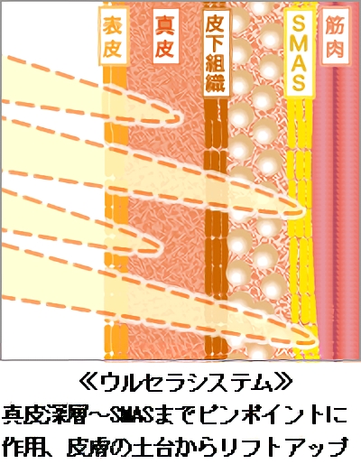 ≪ウルセラシステム≫ 真皮深層～SMASまでピンポイントに作用、皮膚の土台からリフトアップ