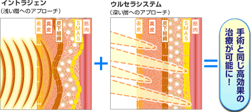 イントラジェン (浅い層へのアプローチ) ＋ ウルセラシステム (深い層へのアプローチ) ＝ 手術と同じ高効果の治療が可能に！