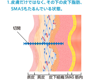 1.皮膚だけではなく、その下の皮下脂肪、SMASもたるんでいる状態。