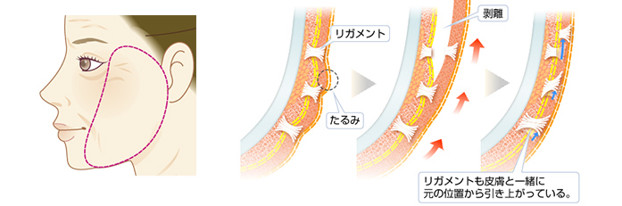 頬のたるみが比較的軽くリガメントごと引き上げることでリフトアップが可能。