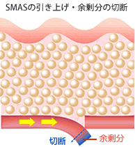 SMASの引き上げ・余剰分の切除