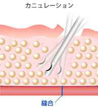 カニュレーション