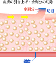 皮膚の引き上げ・余剰分の切除