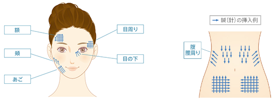 適応部位 額 頬 あご 目周り 目の下 腹 腰周り