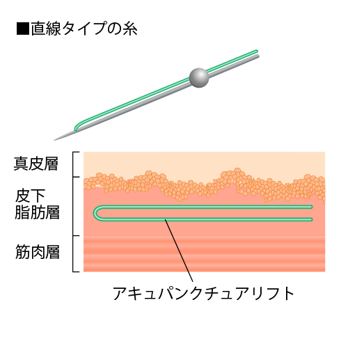 アキュパンクチュアリフト ほほのたるみ エクボ 聖心美容クリニックの美容整形 美容外科