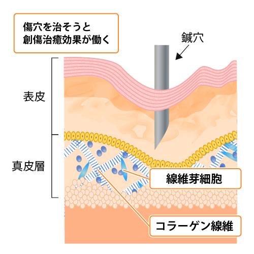 傷穴を治そうと創傷治癒が働く