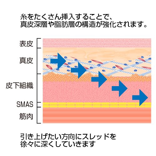 糸をたくさん挿入することで、真皮深層や脂肪層の構造が強化されます。 引き上げたい方向にスレッドを徐々に深くしていきます