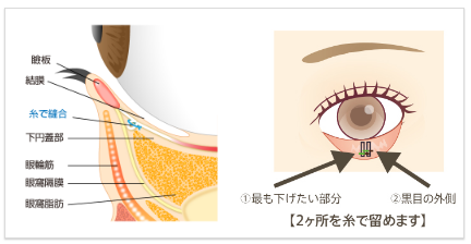 ①最も下げたい部分②黒目の外側【2ヶ所を糸で留めます】