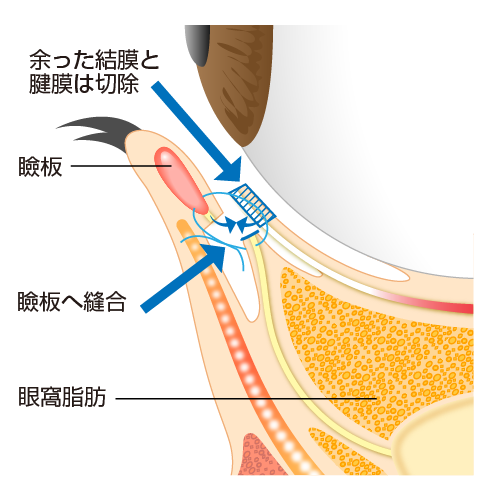 たれ目形成 グラマラスライン 下眼瞼下制術 二重まぶた 目頭切開 涙袋 眼瞼下垂 美容整形 美容外科 美容皮膚科なら聖心美容クリニック