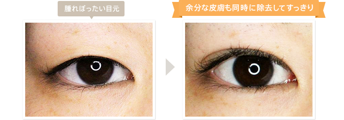 腫れぼったい目元→余分な皮膚も同時に除去してすっきり