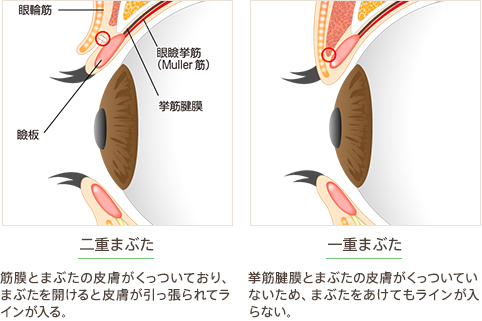 二重まぶた：筋膜とまぶたの皮膚がくっついており、まぶたを開けると皮膚が引っ張られてラインが入る。 一重まぶた：挙筋腱膜とまぶたの皮膚がくっついていないため、まぶたをあけてもラインが入らない。