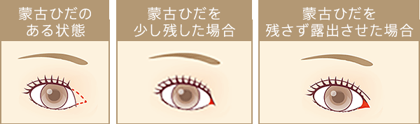 左：目頭切開｜画像に乗っている文言を設置