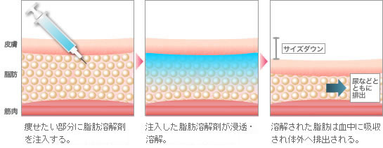 痩せたい部分に脂肪溶解剤を注入する。→注入した脂肪溶解剤が浸透・溶解。→溶解された脂肪は血中に吸収され体外へ排出される。