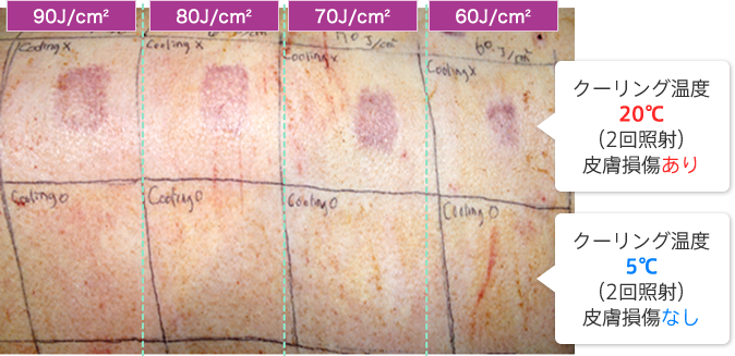 クーリング温度20℃（2回照射）皮膚損傷あり。クーリング温度5℃（2回照射）皮膚損傷なし