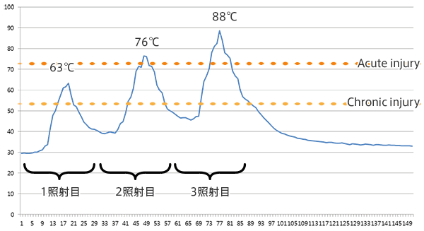 1照射目で63度に達し、脂肪細胞が長期的にダメージを受けて破壊（Chronic injury）されます。2照射目ですでに70℃を超え、3照射目では88度にまで上がり、脂肪細胞が即時的に破壊（Acute injury）されます。