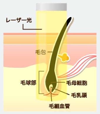 レーザー・光を照射