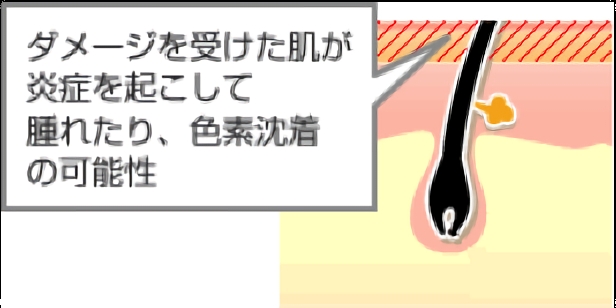 ダメージを受けた肌が炎症を起こして、腫れたり、色素沈着の可能性