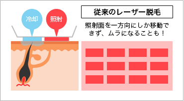 従来のレーザー脱毛,照射面を一方向にしか移動できず、ムラになることも！