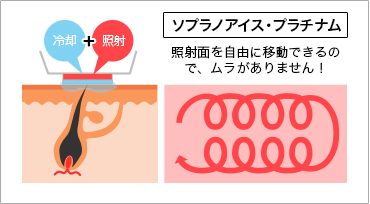 ソプラノアイス・プラチナム,照射面を自由に移動できるので、ムラがありません！