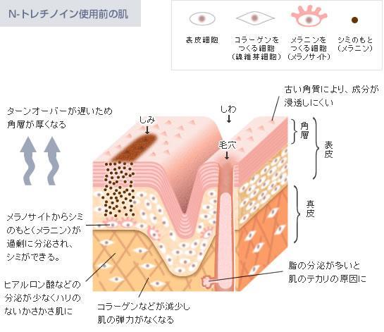 N-トレチノイン使用前の肌