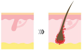 ①毛母細胞を活性化して毛包を強化します。