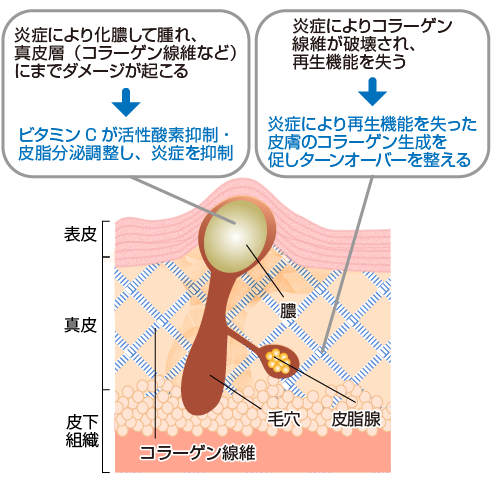 炎症により化膿して腫れ、真皮層（コラーゲン繊維など）にまでダメージが起こる→ビタミンCが活性酸素抑制・皮脂分泌調整し、炎症を抑制。炎症によりコラーゲン線維が破壊され、再生機能を失う→炎症により再生機能を失った皮膚のコラーゲン生成を促しターンオーバーを整える。