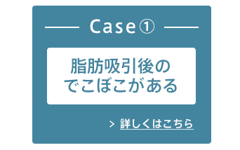 Case1:脂肪吸引後のでこぼこがある 詳しくはこちら