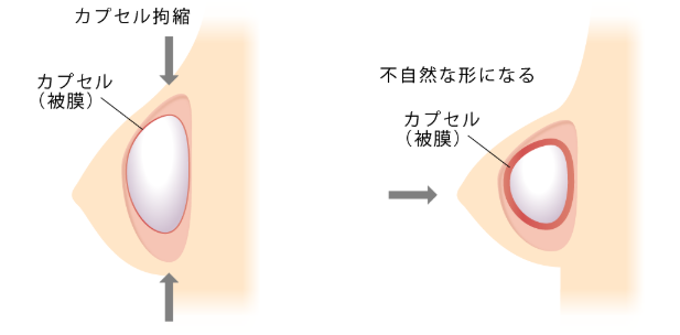 カプセル（膜）が形成され、不自然な形になる