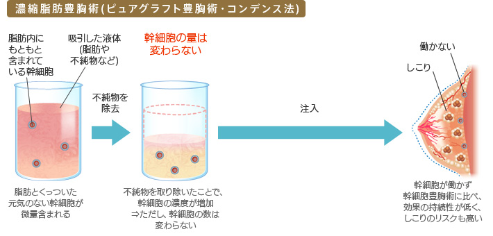 濃縮脂肪豊胸術 (ピュアグラフト豊胸術 コンデンス法) 脂肪とくっついた元気のない幹細胞が微量含まれる 不純物を取り除いたことで、幹細胞の濃度が増加⇒ただし、幹細胞の数は変わらない → 注入 → 幹細胞が働かず幹細胞豊胸術に比べ、効果の持続性が低く、しこりのリスクも高い