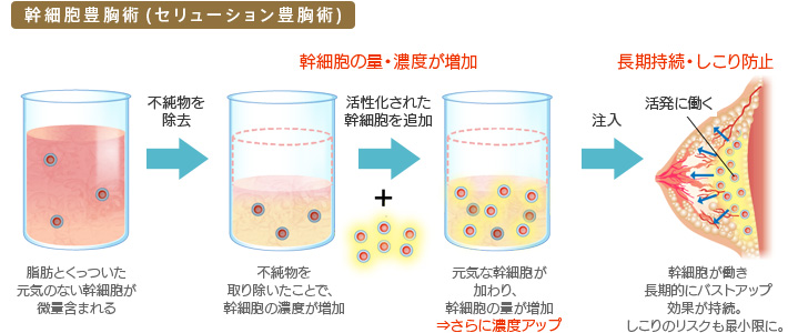 幹細胞豊胸術 (セリューション豊胸術) 脂肪とくっついた元気のない幹細胞が微量含まれる → 不純物を除去 → 幹細胞の量濃度が増加 不純物を取り除いたことで、幹細胞の濃度が増加 → 活性化された幹細胞を追加 → 元気な幹細胞が加わり、幹細胞の量が増加⇒さらに濃度アップ → 注入 → 長期持続・しこり防止 幹細胞が働き長期的にバストアップ効果が持続。しこりのリスクも最小限に。