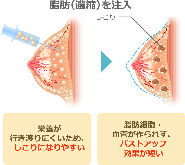 栄養が行き渡りにくいため、しこりになりやすい 脂肪細胞・血管が作られず、バストアップ効果が短い