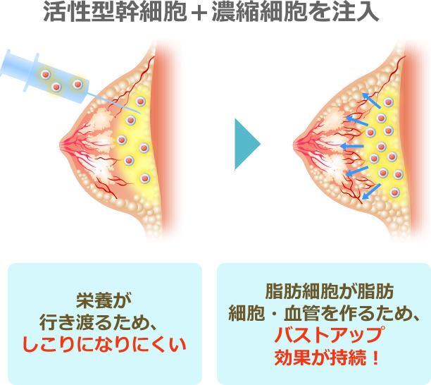 活性型幹細胞+濃縮細胞を注入 栄養が行き渡るため、しこりになりにくい 脂肪細胞が脂肪細胞・血管を作るため、バストアップ効果が持続！