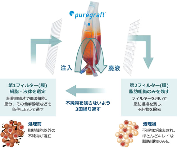 高性能細胞精製器”ピュアグラフト”で不純物80%除去