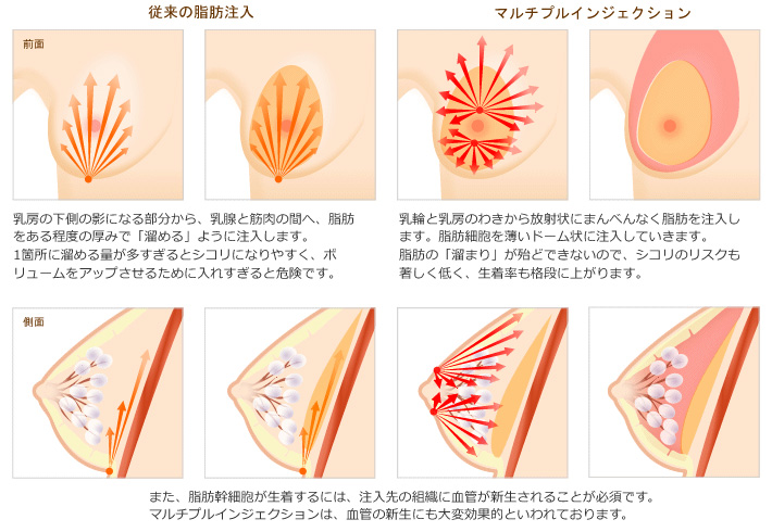 従来の脂肪注入：乳房の下側の影になる部分から、乳腺と筋肉の間へ、脂肪をある程度の厚みで「留める」ように注入します。1箇所に留める量が多すぎるとシコリになりやすく、ボリュームをアップさせるために入れすぎると危険です。マルチプルインジェクション：乳輪と乳房のわきから放射状にまんべんなく脂肪を注入します。脂肪細胞を薄いドーム状に注入していきます。脂肪の「留まり」が殆どできないので、シコリのリスクも著しく低く、生着率も格段に上がります。また、脂肪幹細胞が生着するには、注入先の組織に血管が新生されることが必須です。マルチプルインジェクションは、血管の新生にも大変効果的といわれております。