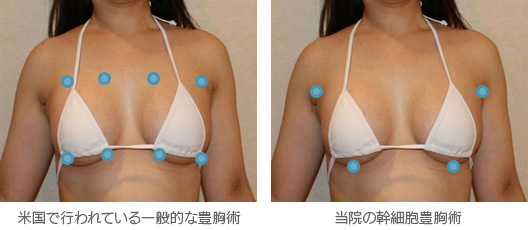 注入する部位数が少ない