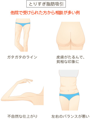 とりすぎ脂肪吸引 他院で受けられた方から相談が多い例 ガタガタのライン 皮膚がたるんで、貧相な印象に 不自然な仕上がり 左右のバランスが悪い