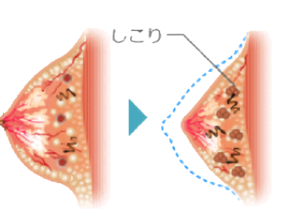 脂肪と一緒に不純物が含まれているため、しこりのリスクも高い