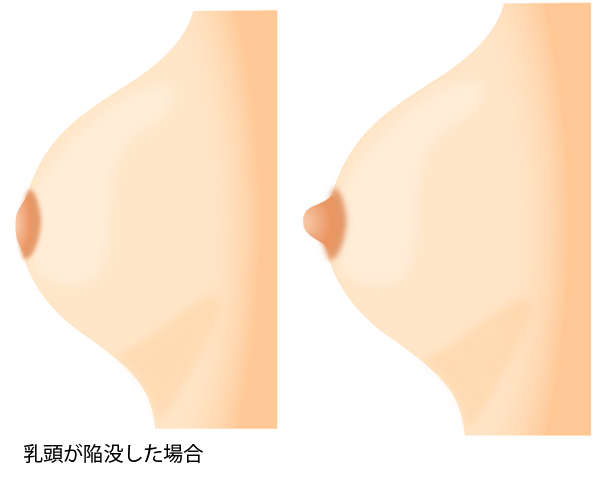 乳頭 陥没