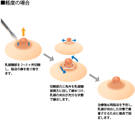 軽度の場合 乳頭頸部を2～3ヶ所切開し、陥没の癖を取り除きます。 切開部の三角弁を乳頭頸部側方に回して締めつけ、乳頭の突出が充分な状態で縫合します。 治療後は再陥没を予防し、乳頭が突出した状態で癒着させるために器具で固定します。