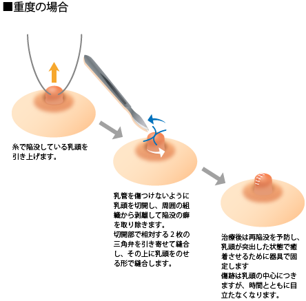 重度の場合 糸で陥没している乳頭を引き上げます。 乳管を傷つけないように乳頭を切開し、周囲の組織から剥離して陥没の癖を取り除きます。切開部で相対する2枚の三角弁を引き寄せて縫合し、その上に乳頭をのせる形で縫合します。 治療後は再陥没を予防し、乳頭が突出した状態で癒着させるために器具で固定します。傷痕は乳頭の中心につきますが、時間とともに目立たなくなります。