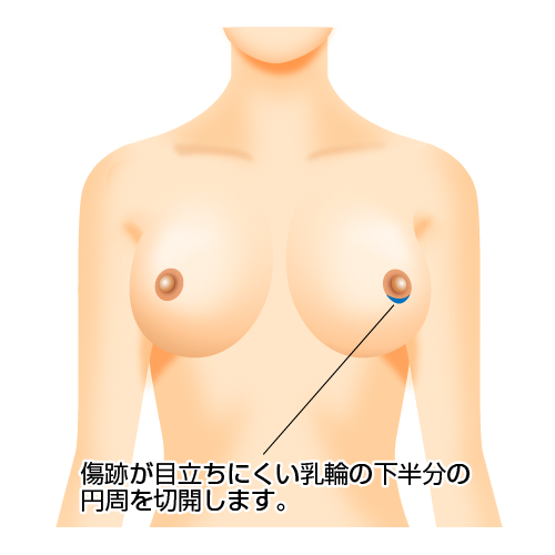 傷跡が目立ちにくい乳輪の下半分の円周を切開します。