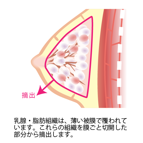乳腺・脂肪組織は、薄い被膜で覆われています。これらの組織を膜ごと切開した部分から摘出します。