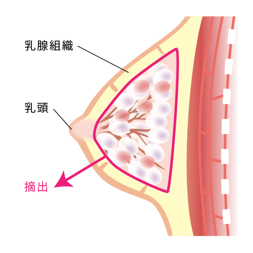 乳房切除