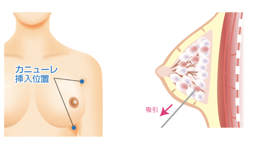 FTM 胸 