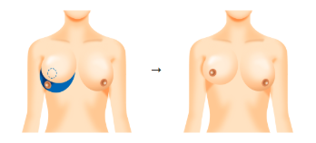 乳房の下部（アンダー）から切除する方法