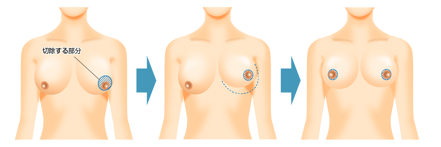 ラウンド法（乳輪吊り上げ）