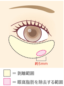 剥離範囲 眼窩脂肪を除去する範囲
