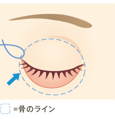次に、眼輪筋肉を目尻の方へ吊り上げて張りを出し、頬骨の骨膜に固定します